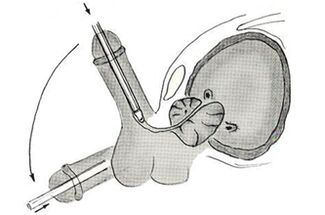 Schema der endoskopischen Penisvergrößerungsoperation. 