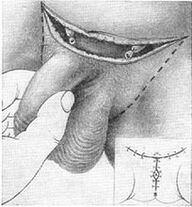 Chirurgische Verlängerung des Penis durch Entfernung seines verborgenen Teils